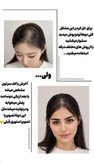 عکس محصول جلو مویی چنگالی (حجم دهنده جلوی سر)
